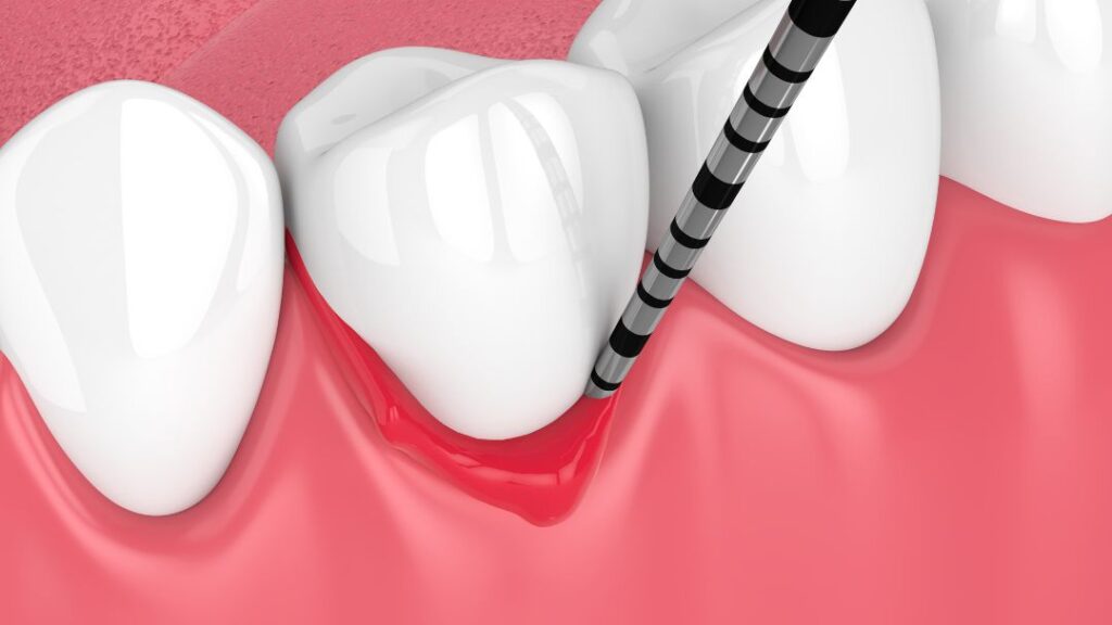 Periodontia: Cuidando da Saúde das Gengivas