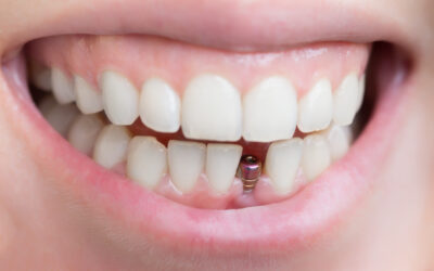 implante-dentario